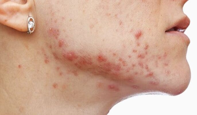 Learn What Is Fungal Acne Girls Thinking Global